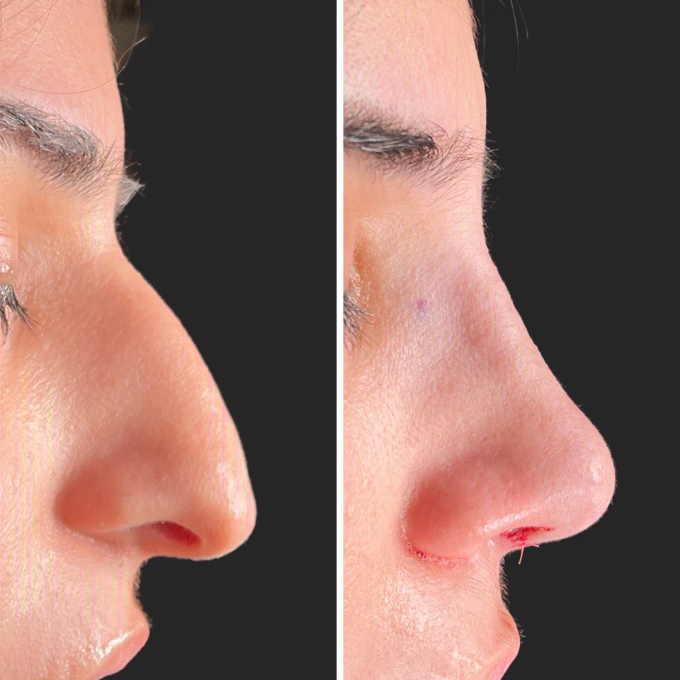 rhinoplasty before after