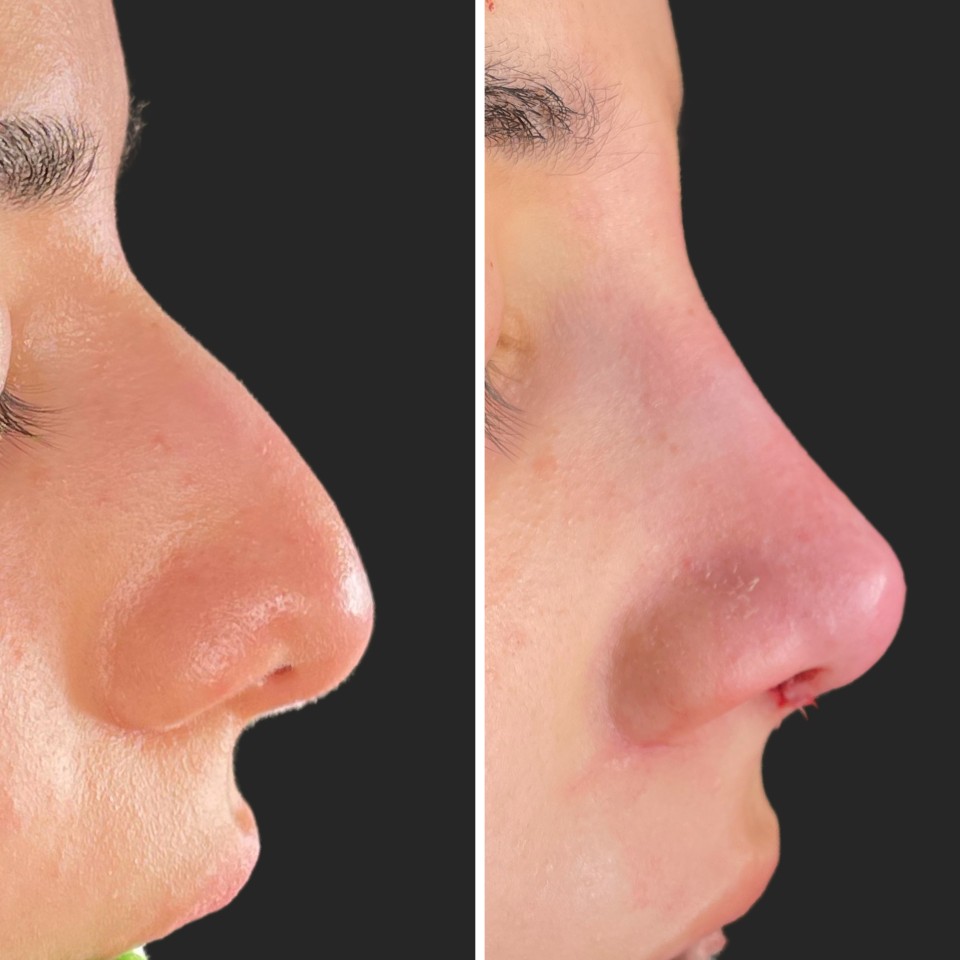 rhinoplasty before after