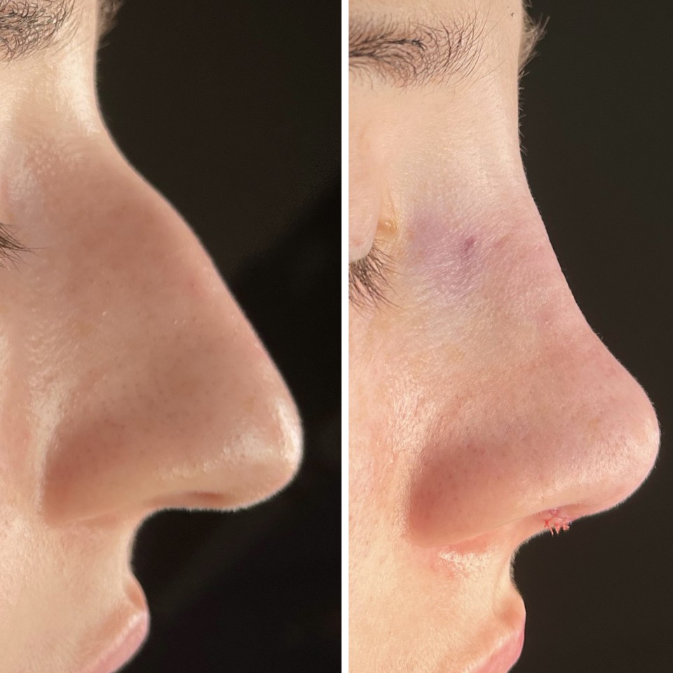 rhinoplasty before after